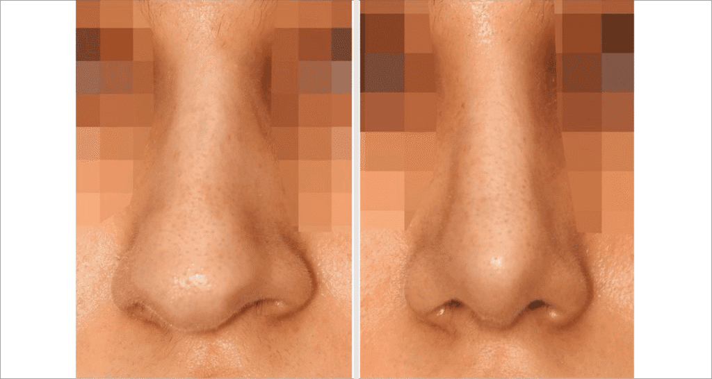 Vorher/Nachher Ergebnis: Bilder Nasenkorrektur