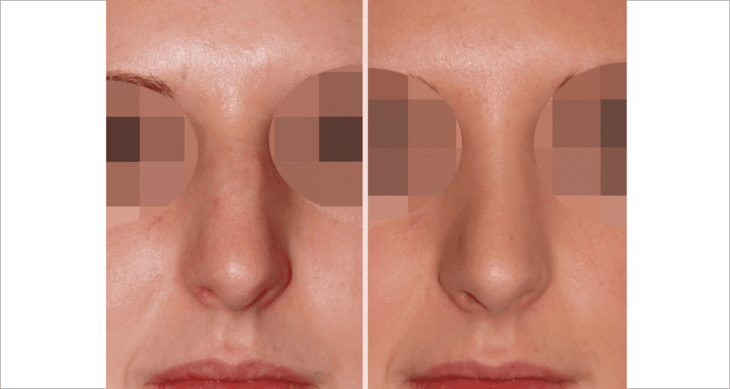 Vorher/Nachher Ergebnis: Bilder Nasenkorrektur
