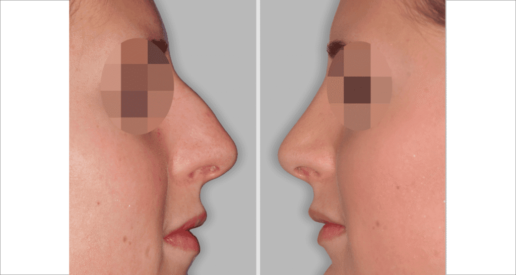 Vorher/Nachher Ergebnis: Bilder Nasenkorrektur