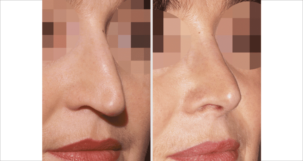 Vorher/Nachher Ergebnis: Bilder Nasenkorrektur