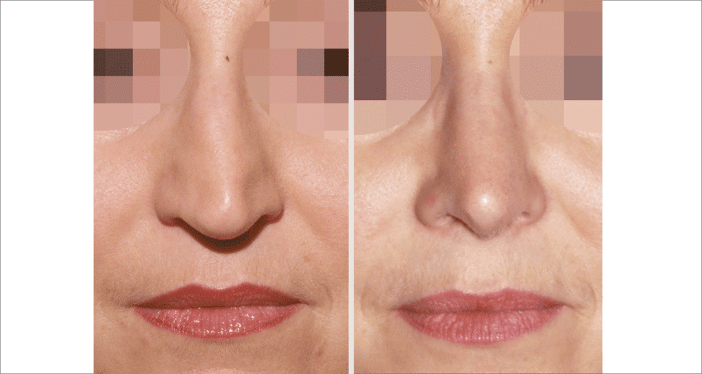 Vorher/Nachher Ergebnis: Bilder Nasenkorrektur