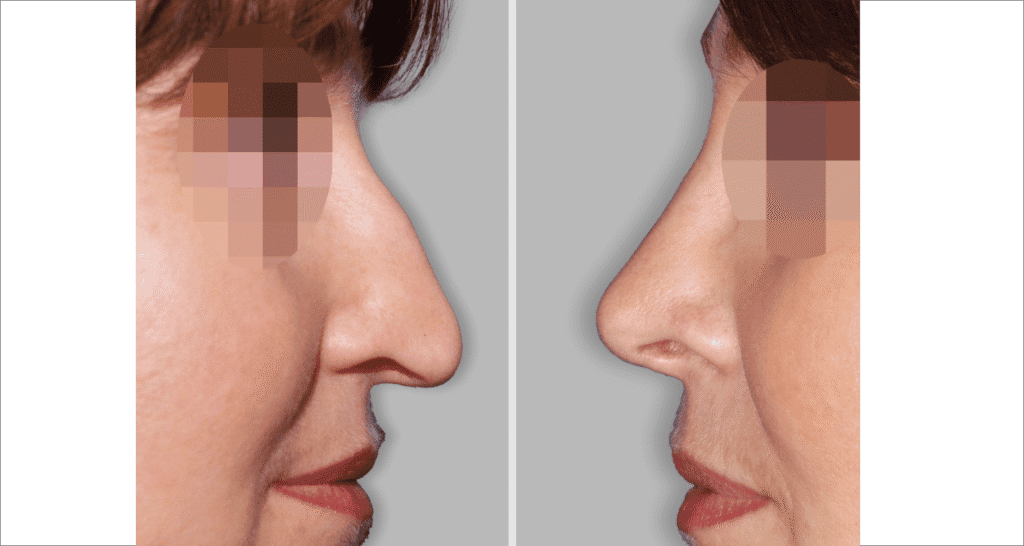 Vorher/Nachher Ergebnis: Bilder Nasenkorrektur