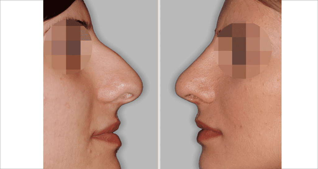 Vorher/Nachher Ergebnis: Bilder Nasenkorrektur