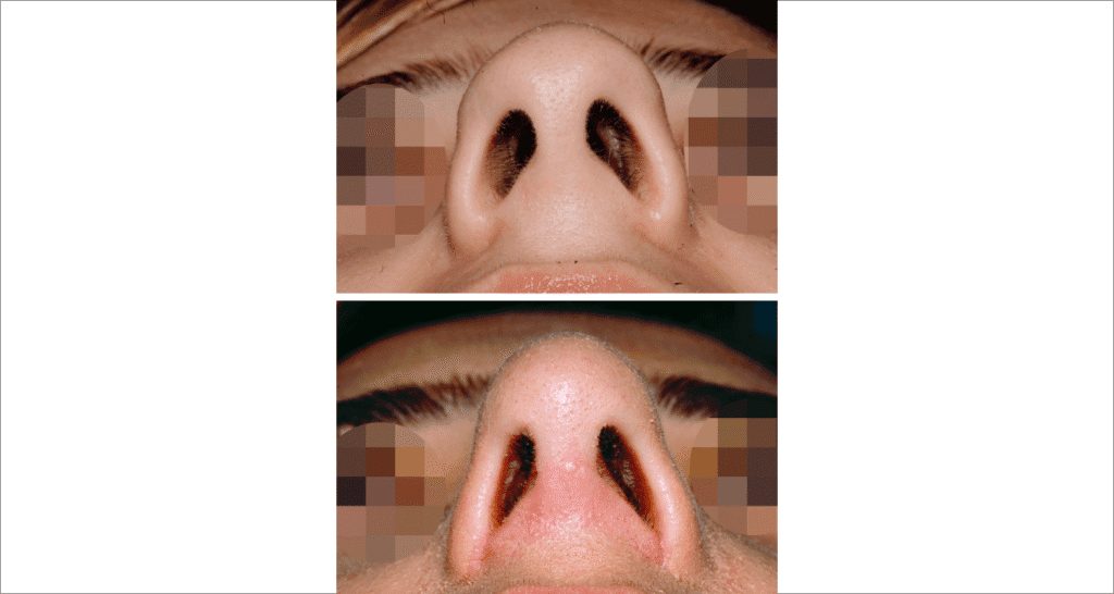 Vorher/Nachher Ergebnis: Bilder Nasenkorrektur