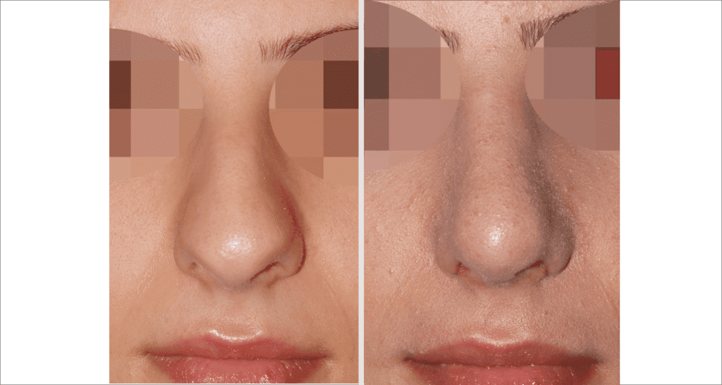 Vorher/Nachher Ergebnis: Bilder Nasenkorrektur