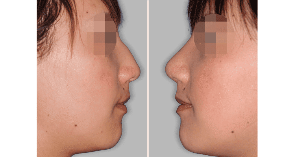 Vorher/Nachher Ergebnis: Bilder Nasenkorrektur