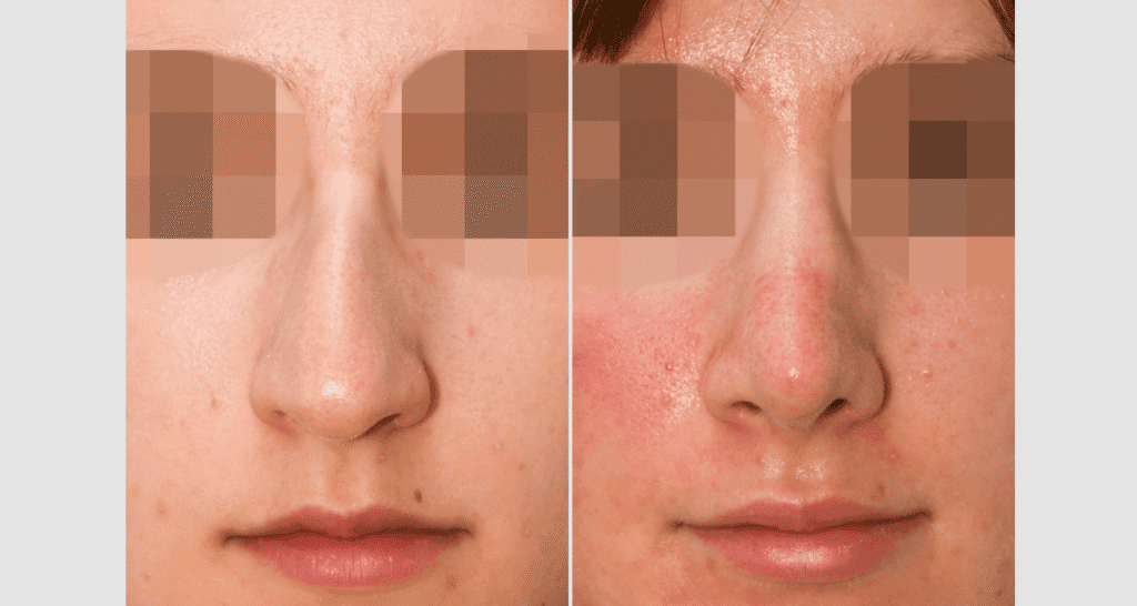 Vorher/Nachher Ergebnis: Bilder Nasenkorrektur