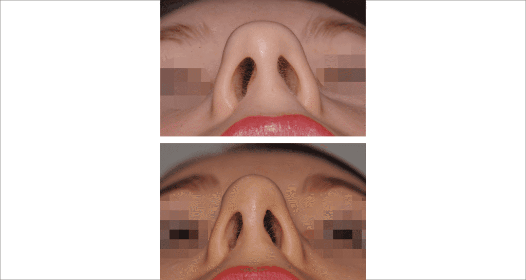 Vorher/Nachher Ergebnis: Bilder Nasenkorrektur