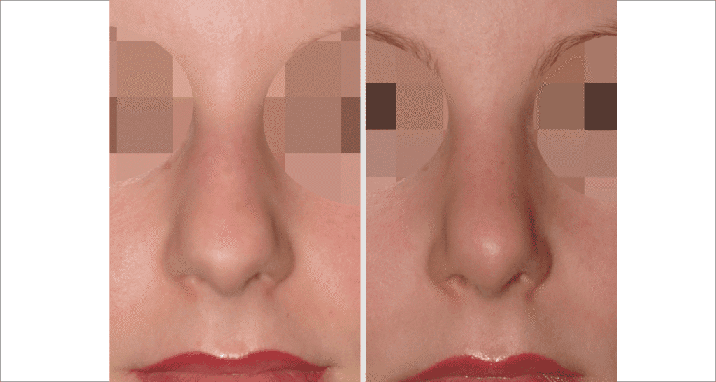 Vorher/Nachher Ergebnis: Bilder Nasenkorrektur
