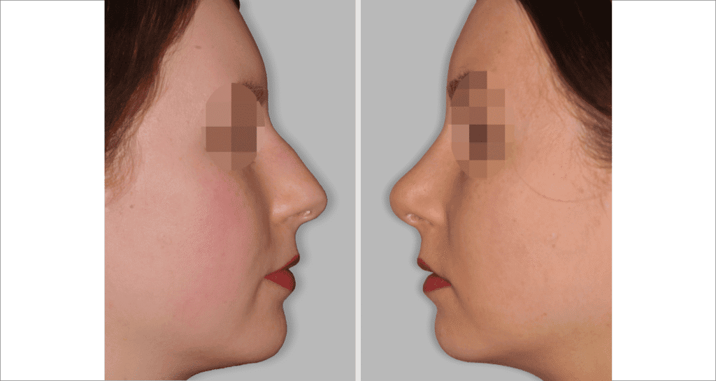 Vorher/Nachher Ergebnis: Bilder Nasenkorrektur