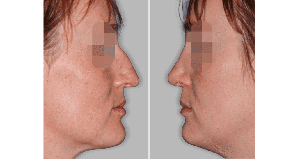 Vorher/Nachher Ergebnis: Bilder Nasenkorrektur