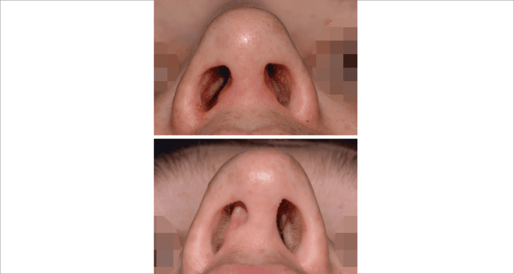 Vorher/Nachher Ergebnis: Bilder Nasenkorrektur