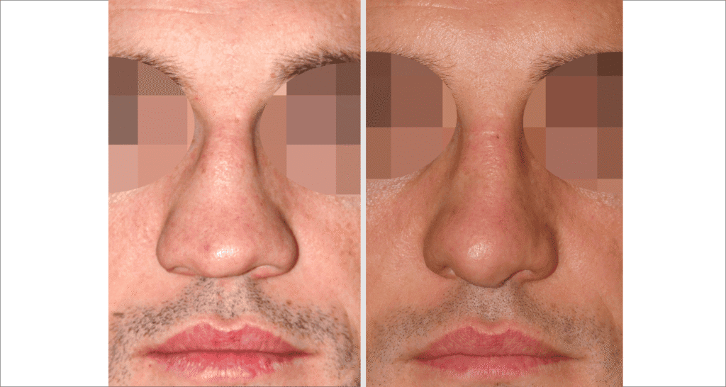 Vorher/Nachher Ergebnis: Bilder Nasenkorrektur