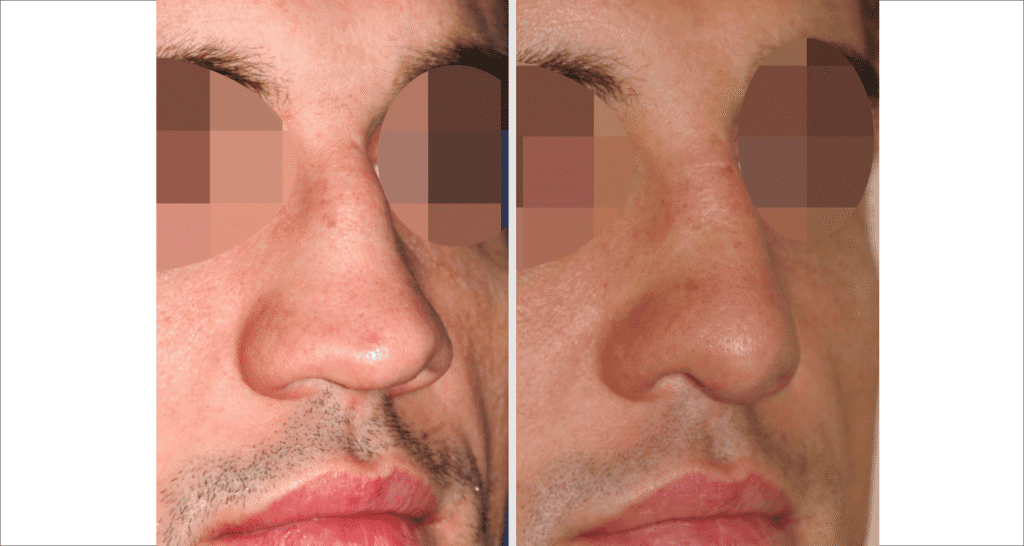 Vorher/Nachher Ergebnis: Bilder Nasenkorrektur