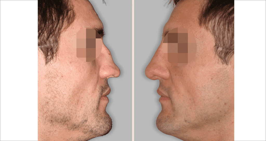 Vorher/Nachher Ergebnis: Bilder Nasenkorrektur