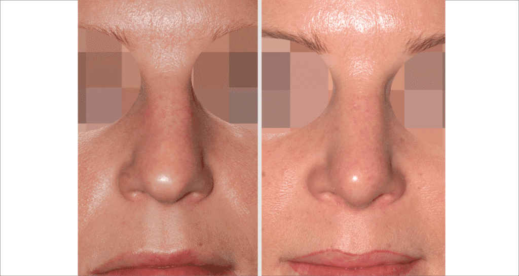 Vorher/Nachher Ergebnis: Bilder Nasenkorrektur