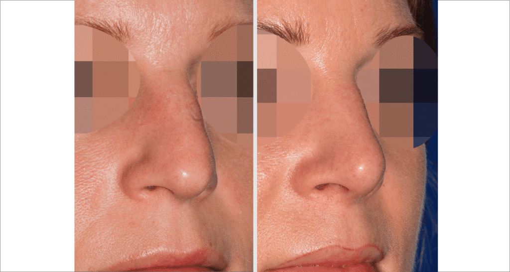 Vorher/Nachher Ergebnis: Bilder Nasenkorrektur