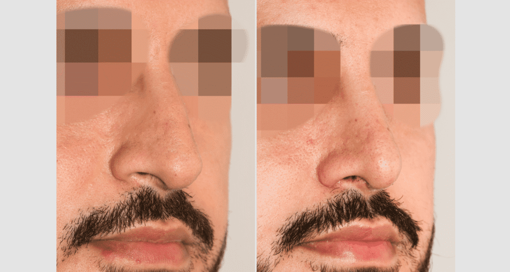 Vorher/Nachher Ergebnis: Bilder Nasenkorrektur