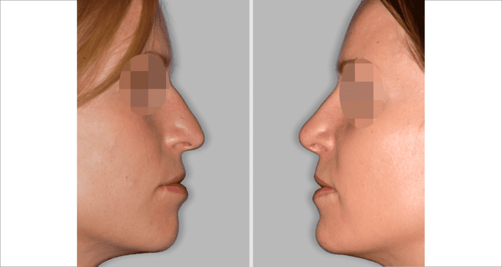 Vorher/Nachher Ergebnis: Bilder Nasenkorrektur