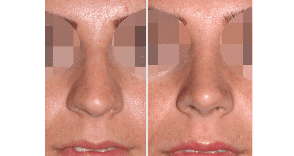 Vorher/Nachher Ergebnis: Bilder Nasenkorrektur