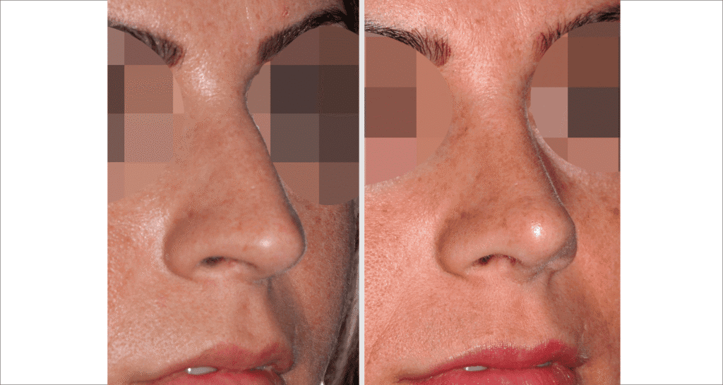 Vorher/Nachher Ergebnis: Bilder Nasenkorrektur