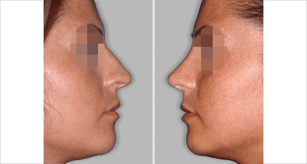 Vorher/Nachher Ergebnis: Bilder Nasenkorrektur