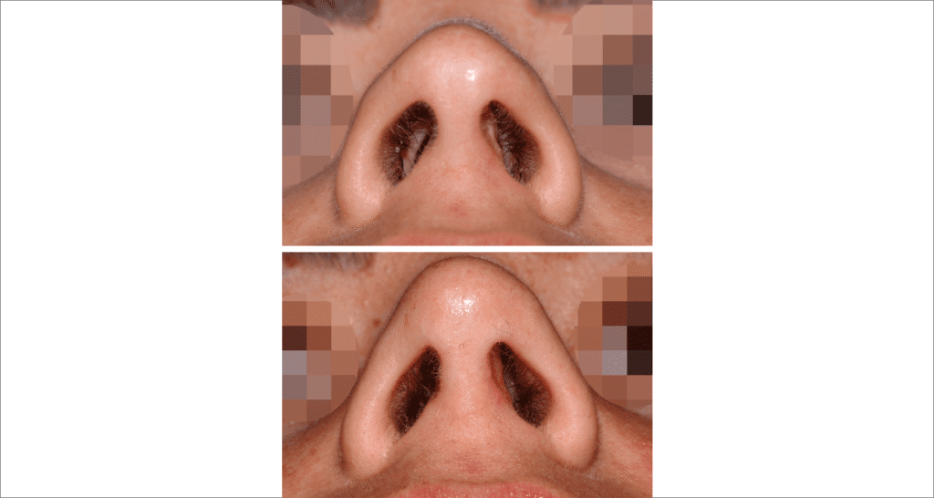 Vorher/Nachher Ergebnis: Bilder Nasenkorrektur