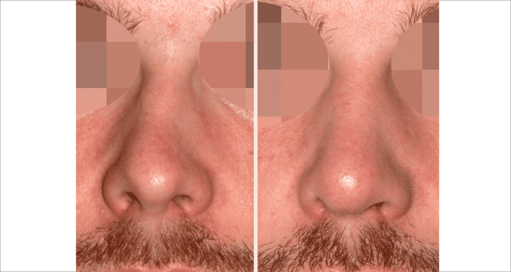 Vorher/Nachher Ergebnis: Bilder Nasenkorrektur