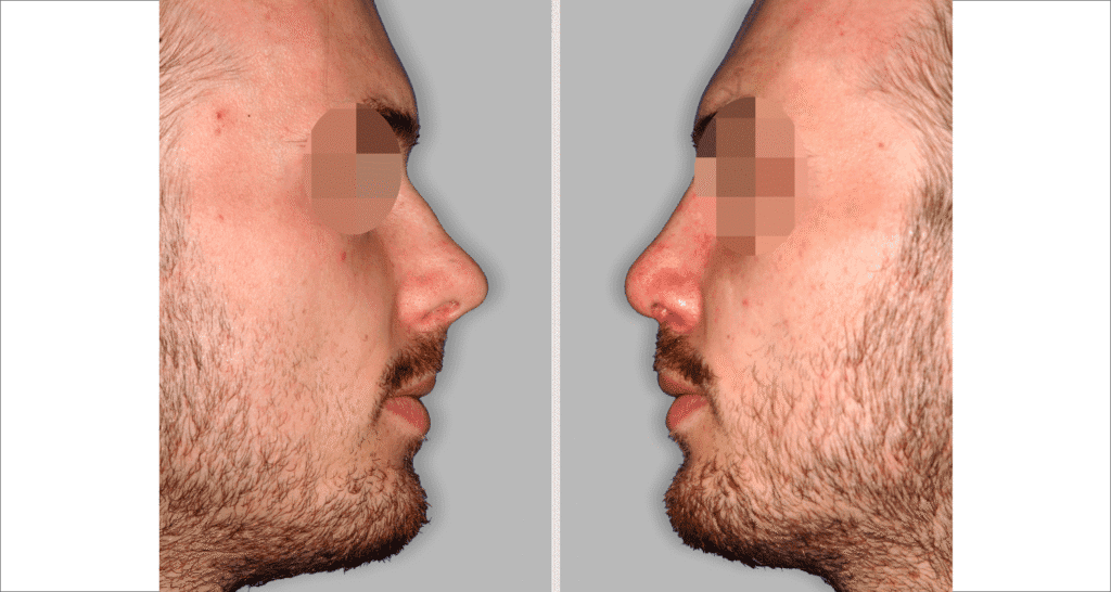 Vorher/Nachher Ergebnis: Bilder Nasenkorrektur