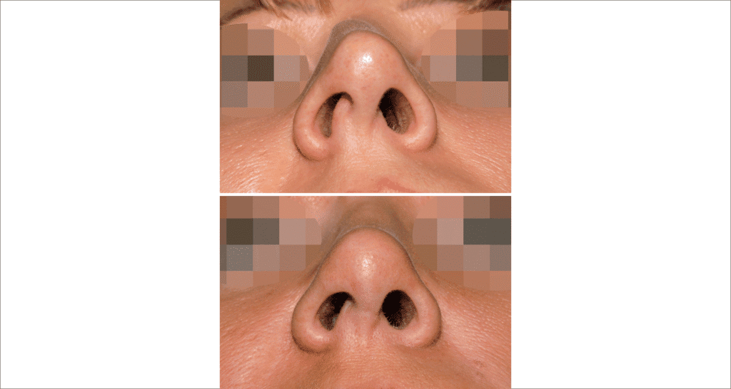 Vorher/Nachher Ergebnis: Bilder Nasenkorrektur