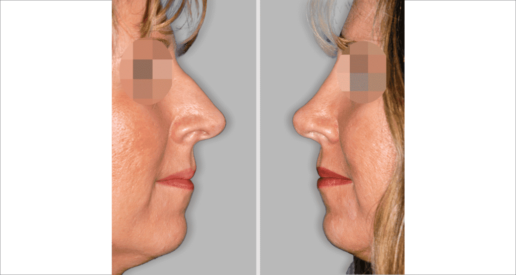 Vorher/Nachher Ergebnis: Bilder Nasenkorrektur