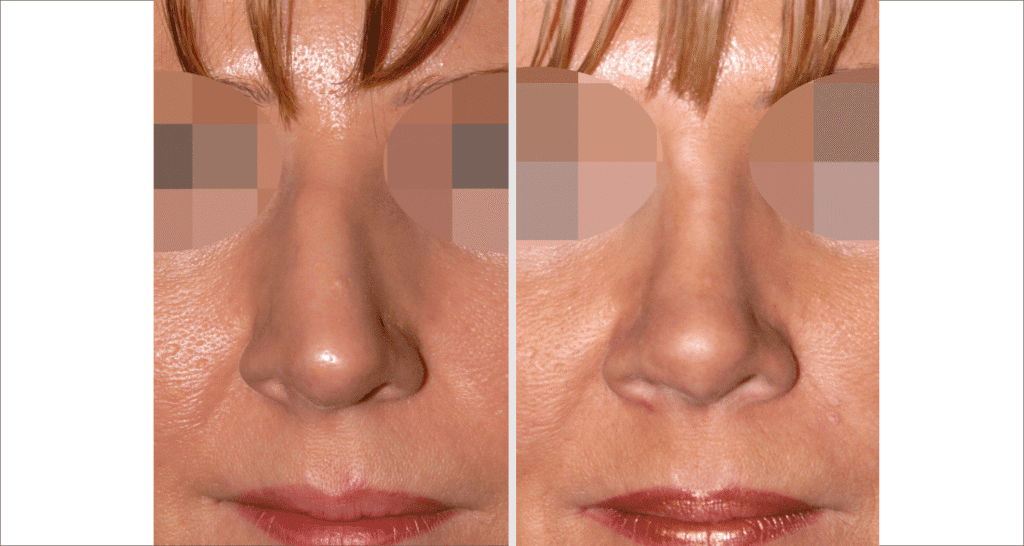 Vorher/Nachher Ergebnis: Bilder Nasenkorrektur