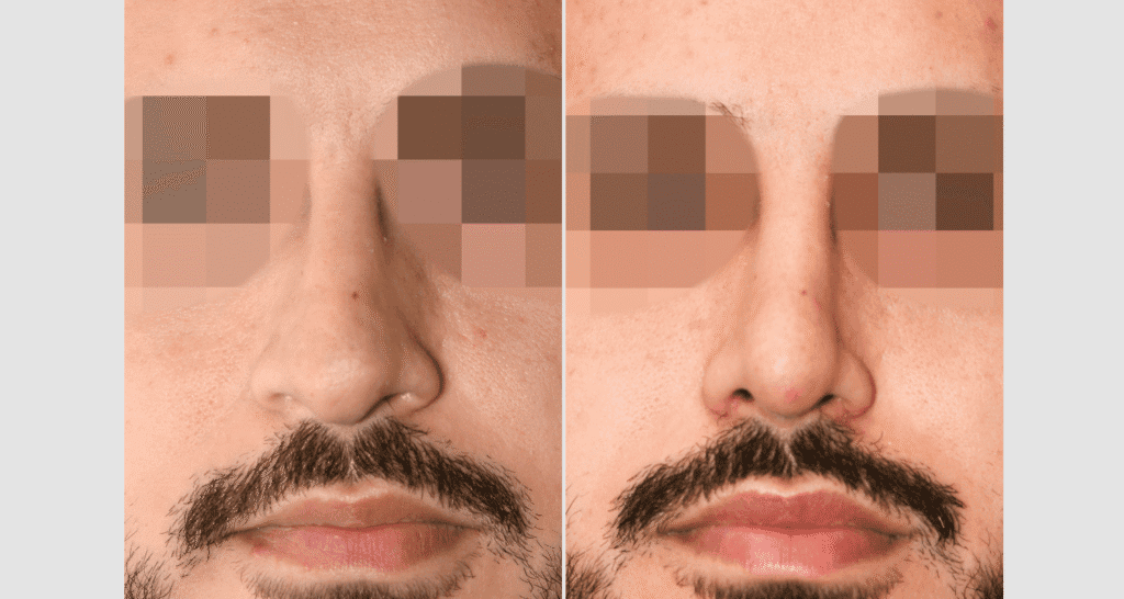 Vorher/Nachher Ergebnis: Bilder Nasenkorrektur