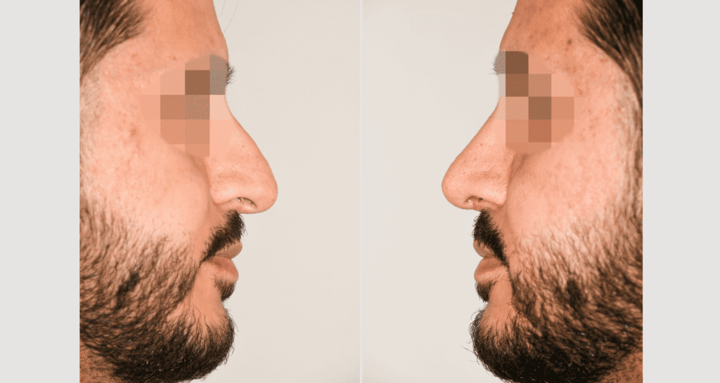 Vorher/Nachher Ergebnis: Bilder Nasenkorrektur