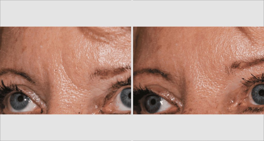 Nahaufnahme von Stirn und Augenpartie vor und nach Hautbehandlung.