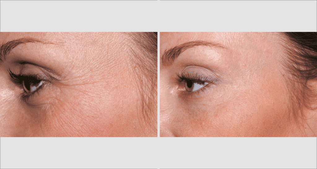 Vorher-Nachher Vergleich von Hautverjüngung bei Anti-Aging Behandlung.