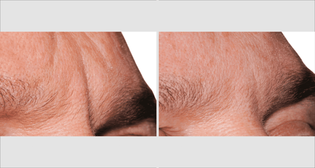 Nahaufnahme von Haut vor und nach der Rasur, Hautpflege, Hautreinigung.