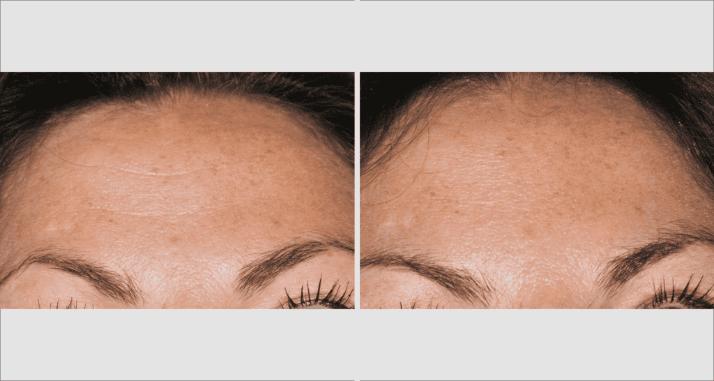 Vorher/Nachher Ergebnis: Botox 4 1024x546