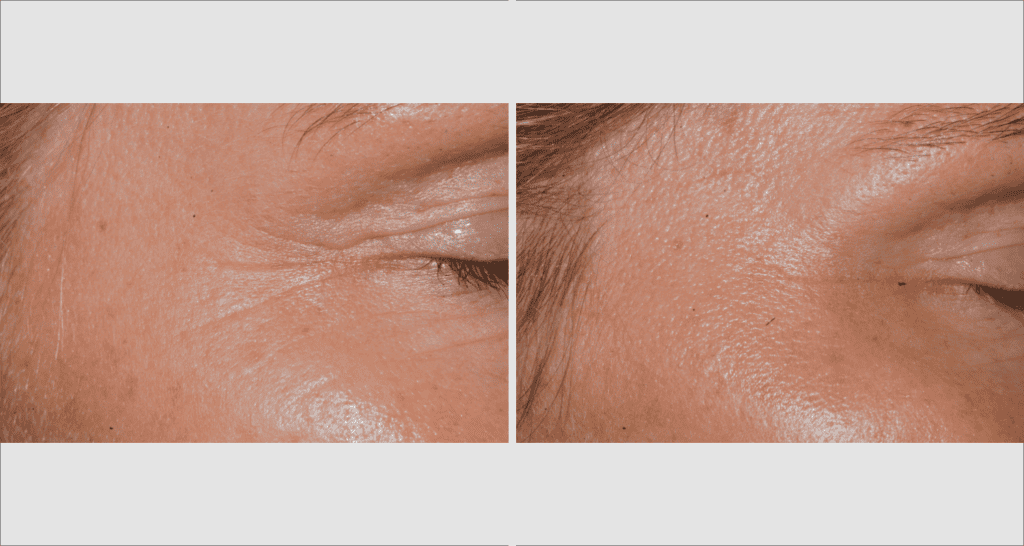 Vorher/Nachher Ergebnis: Botox 5 1024x546