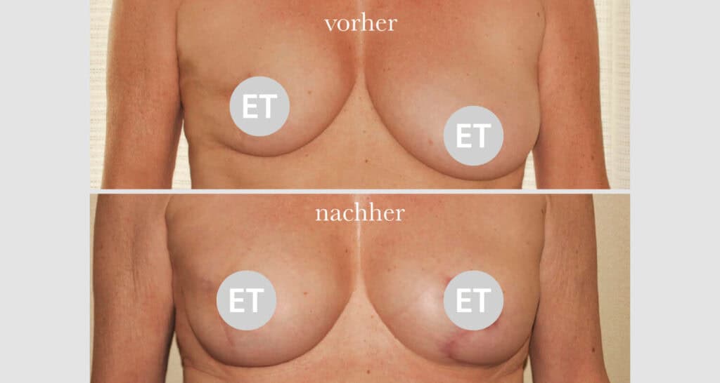 Vorher/Nachher Ergebnis: Brustrekonsturktion