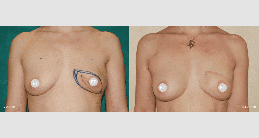 Vorher/Nachher Ergebnis: Brustrekonsturktion