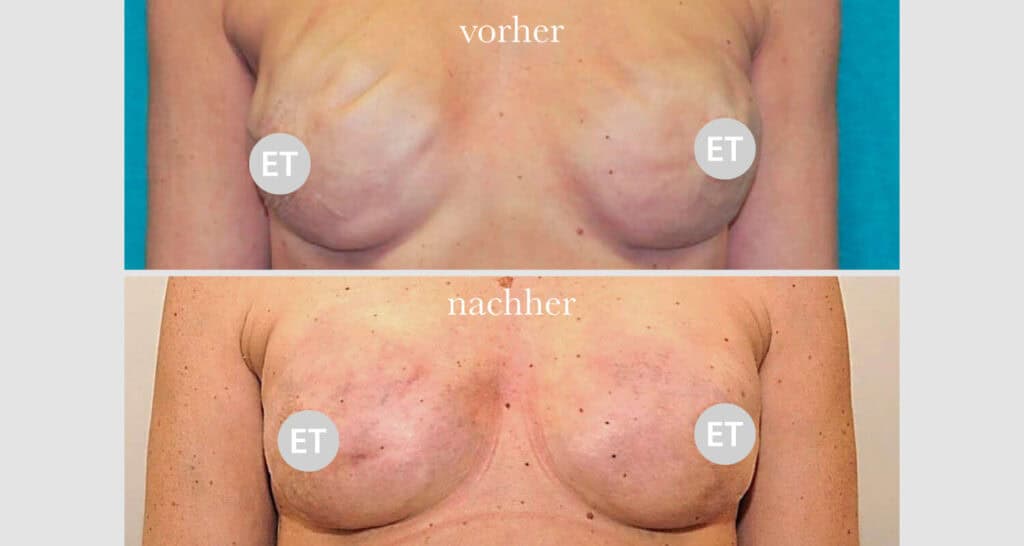 Vorher/Nachher Ergebnis: Brustrekonsturktion
