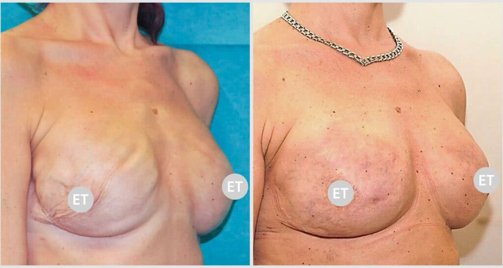 Vorher/Nachher Ergebnis: Brustrekonsturktion