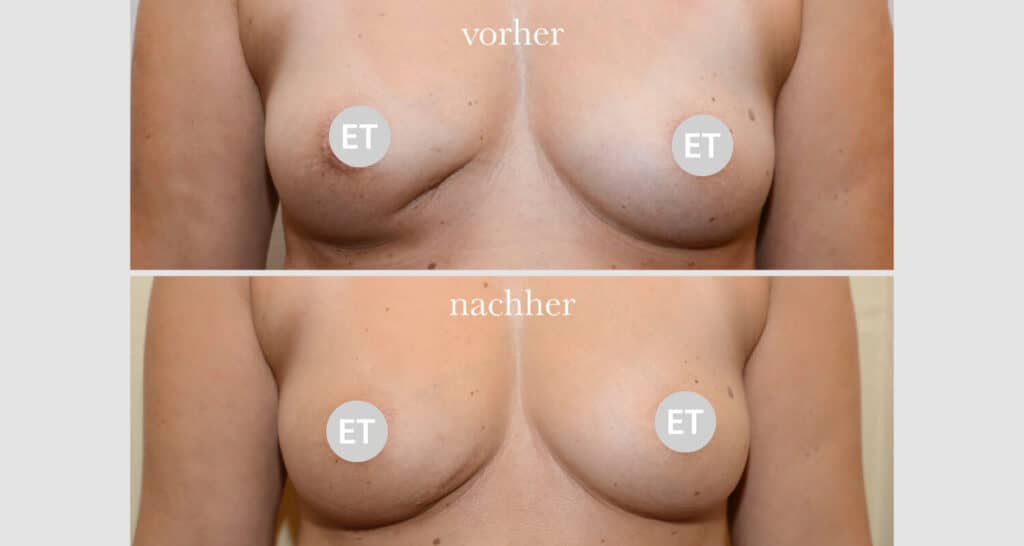 Vorher/Nachher Ergebnis: Brustrekonsturktion