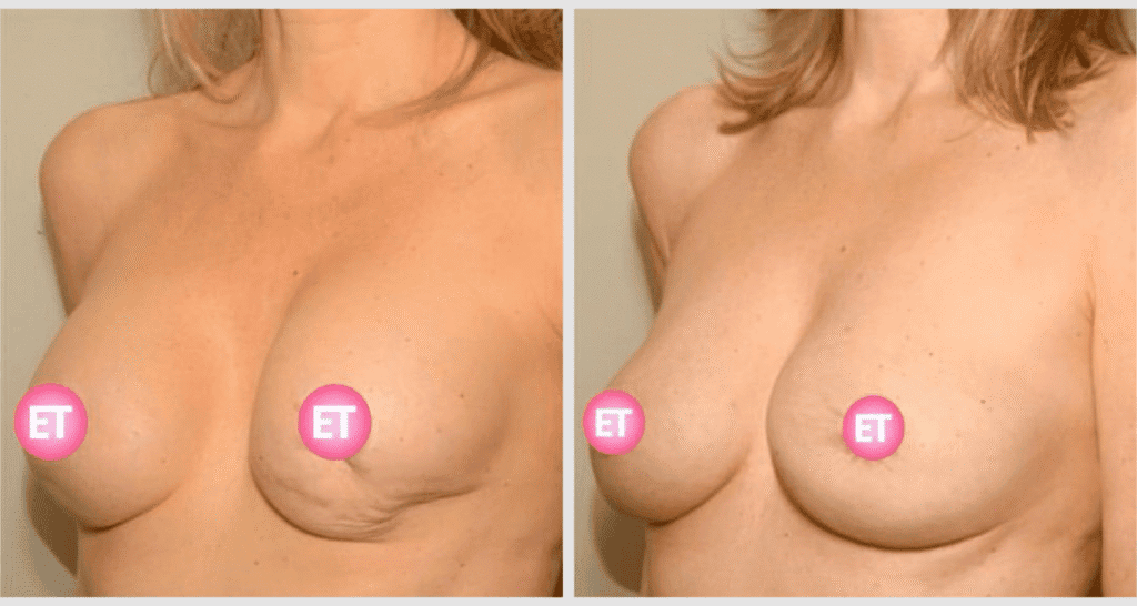 Vorher/Nachher Ergebnis: Brustrekonsturktion