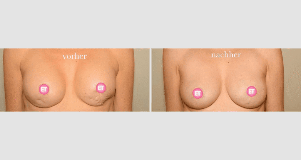 Vorher/Nachher Ergebnis: Brustrekonsturktion