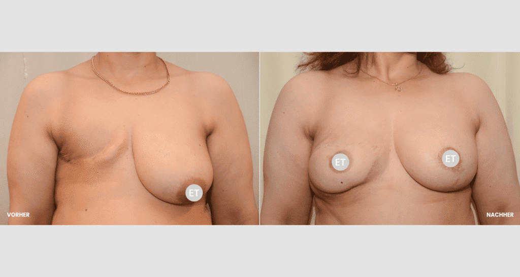 Vorher/Nachher Ergebnis: Brustrekonsturktion