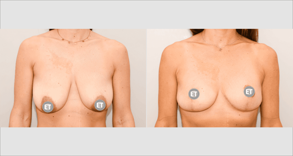 Vorher/Nachher Ergebnis: Bruststraffung