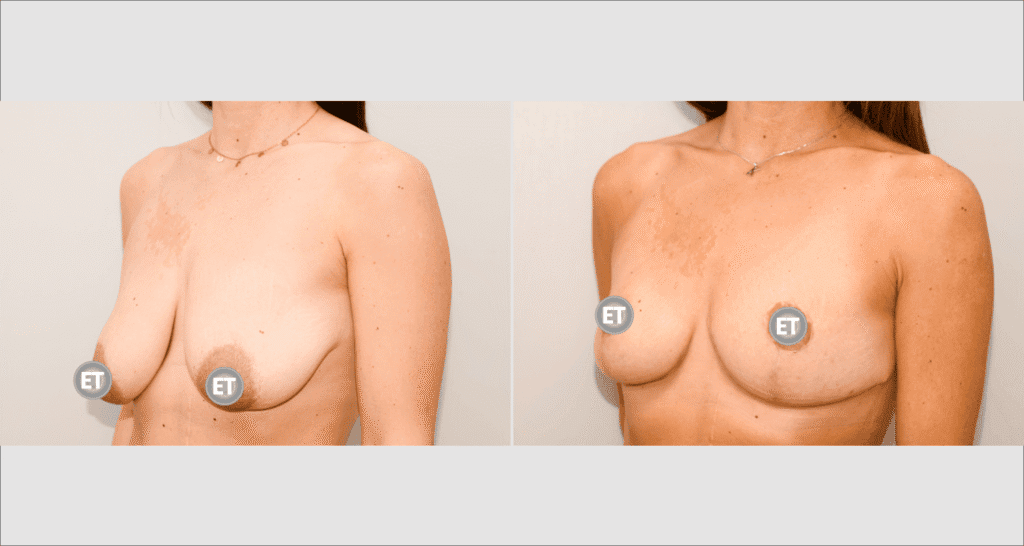 Vorher/Nachher Ergebnis: Bruststraffung