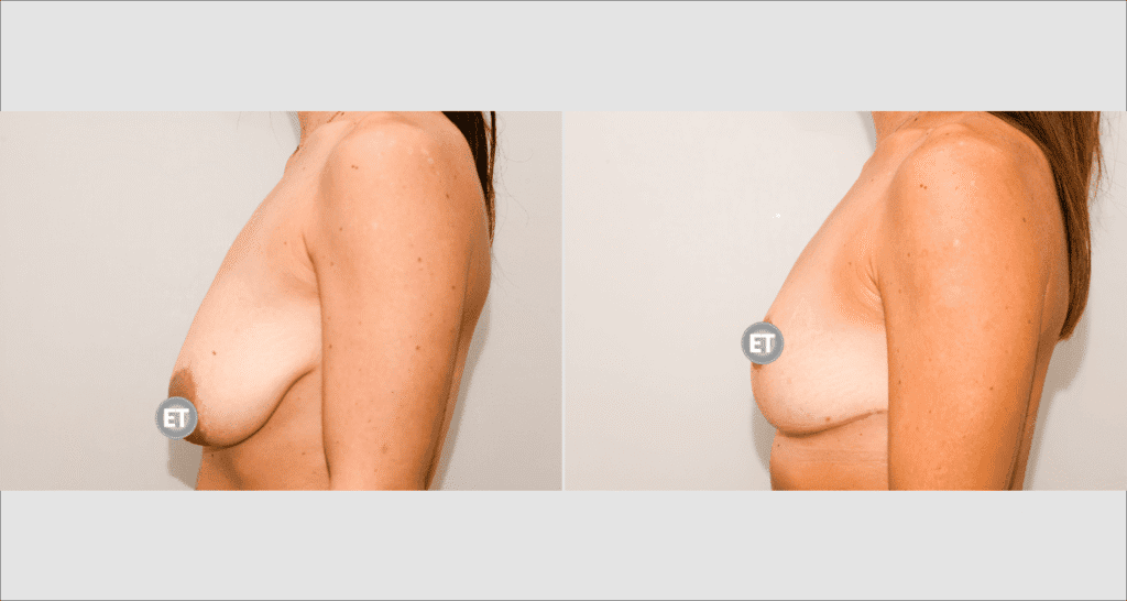 Vorher/Nachher Ergebnis: Bruststraffung